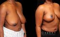 Procedures Depicted:  Breast reduction with lift