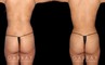 Multiple angle view of Caucasian patient in her mid-30s before and after mini Brazilian butt lift surgery and combined 360 liposuction for body contouring and butt augmentation. Liposuction provided improved abdominal contouring focusing on the abdomen, waist, and tailbone areas. The transferred fat settled well into round-shaped buttocks for a stable cosmetic enhancement as part of this skinny BBL.