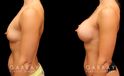 Patient photos showing before and after her breast augmentation procedure, with notable breast size increase while maintaining a balanced aesthetic.