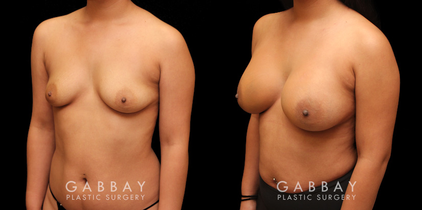 Photos for female patient before and after silicone implant procedure. Note the robust increase in breast size while continuing to match her body’s aesthetic for an aligned appearance.
