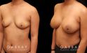 Photos for female patient before and after silicone implant procedure. Note the robust increase in breast size while continuing to match her body’s aesthetic for an aligned appearance.