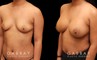Photos for female patient before and after silicone implant procedure. Note the robust increase in breast size while continuing to match her body’s aesthetic for an aligned appearance.