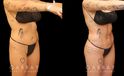 Female patient before and after BBL surgery combined with 360 liposuction. Slimmer waist and enhanced roundness of butt produced an impressive figure and silhouette from all angles.