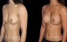 Before-and-after photos for breast augmentation showing fully recovered patient. Note the lack of visible scarring despite the dramatic increase to bust volume. Balanced, round breast shape enhances the patient’s natural figure.