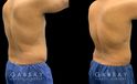 Male patient following 360 liposuction to the abdomen, sides, and back for a more youthful contour while maintaining a masculine feel to the body shape. The result is a tighter overall torso appearance.