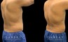 Male patient following 360 liposuction to the abdomen, sides, and back for a more youthful contour while maintaining a masculine feel to the body shape. The result is a tighter overall torso appearance.