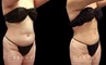 Abdominal liposuction results for a Caucasian patient who wanted to address pockets of belly fat that would not go away. The procedure removed the fat and produced a flat profile with a tighter tummy appearance.