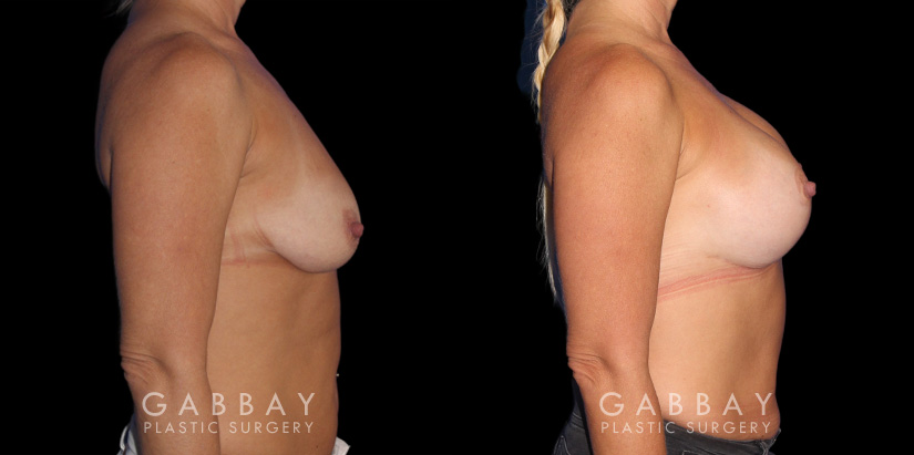 Procedures Depicted:  Wise Mastopexy with Silicone Breast Implants