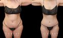 Note the loose skin tightened over the lower abdomen, with no hanging pockets of fat following the patient’s tummy tuck procedure. Before and after photos demonstrate the restoration of a youthful physique and smoother, firm-looking skin around the stomach.