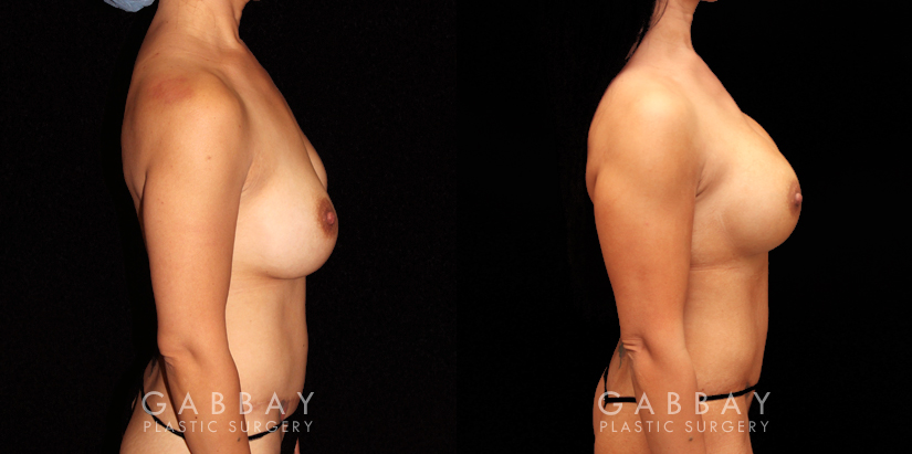 Procedures Depicted:  R&R Silicone, Capsuloraphy, Pubis Lift, Scar Revision