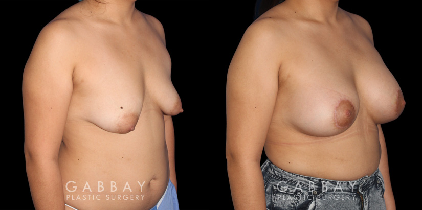Procedures Depicted:  Breast Augmentation – Silicone & Lift