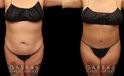 Tummy tuck before and after photos, along with combined liposuction, breast lift, and breast augmentation. Abdominal tightening enhanced the increase in breast volume for a curvier, fitter aesthetic.