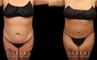 Tummy tuck before and after photos, along with combined liposuction, breast lift, and breast augmentation. Abdominal tightening enhanced the increase in breast volume for a curvier, fitter aesthetic.