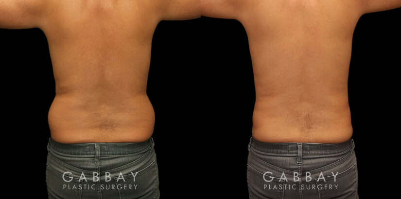 Procedures Depicted:  liposuction and j plasma to full abdomen