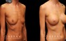 Patient wanted dramatic increase in breast volume using silicone implants. Breast position was not changed, with the main focus being boost to size and roundness of the breasts.