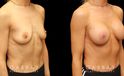 Silicone breast augmentation results after full recovery. Multi-angle view shows the boost to volume from each side for an alluring profile.