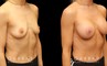 Silicone breast augmentation results after full recovery. Multi-angle view shows the boost to volume from each side for an alluring profile.