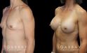 Breast augmentation results for patient with slim and fit body type. The silicone implants were chosen to match this tighter physique for a natural balance.