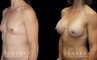 Breast augmentation results for patient with slim and fit body type. The silicone implants were chosen to match this tighter physique for a natural balance.
