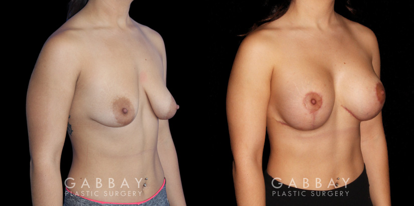 Procedures Depicted:  Breast Augmentation w/ Mastopexy – Silicone