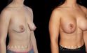Procedures Depicted:  Breast Augmentation w/ Mastopexy – Silicone