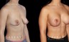 Procedures Depicted:  Breast Augmentation w/ Mastopexy – Silicone