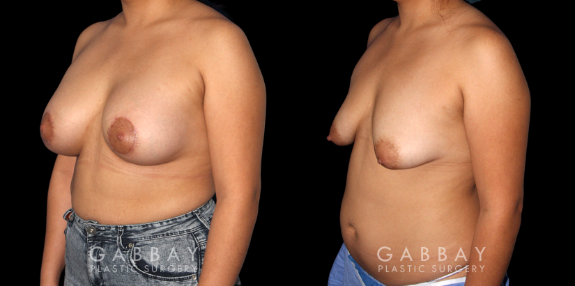 Procedures Depicted:  Breast Augmentation – Silicone & Lift