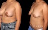 Procedures Depicted:  Breast Augmentation – Silicone & Lift