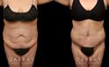 Patient before and after tummy tuck combined with breast lift. The tightening of the abdomen along with the repositioning of the breasts creates a more balanced aesthetic with tighter skin.