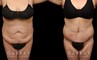 Patient before and after tummy tuck combined with breast lift. The tightening of the abdomen along with the repositioning of the breasts creates a more balanced aesthetic with tighter skin.