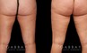 Patient 04 Back View Thigh Lift Gabbay Plastic Surgery