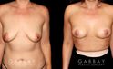 Procedures Depicted:  Mastopexy and Liposuction