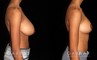 Patient 04 Right Side View Breast Reduction Gabbay Plastic Surgery