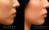 Patient 07 Right Side View Lip Augmentation Gabbay Plastic Surgery