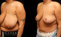 Procedures Depicted:  Breast reduction with lift