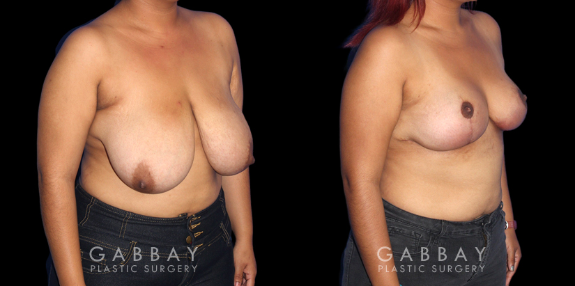 Procedures Depicted:  Mastopexy