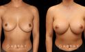 This is a breast augmentation patient who had significant asymmetry. She underwent silicone breast implant augmentation, using different sized high profile Allergan Natrelle Soft Touch implants: 365 cc on the left, 435 cc on the right. Implants were placed below the muscle in a dual plane configuration using an incision that is beautifully hidden within the breast fold.