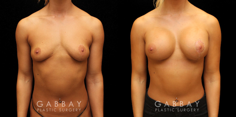 Procedures Depicted:  Implants repeal & replacement (left)