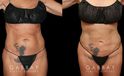 Liposuction before-and-after for female patient who wanted subtle fat removal around the lower abdomen to target stubborn belly fat. Her results show a decrease in lower abdominal bulge for a flatter contour.