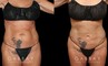 Liposuction before-and-after for female patient who wanted subtle fat removal around the lower abdomen to target stubborn belly fat. Her results show a decrease in lower abdominal bulge for a flatter contour.