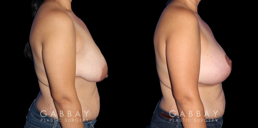Procedures Depicted:  Breast Augmentation – Silicone, Mastopexy
