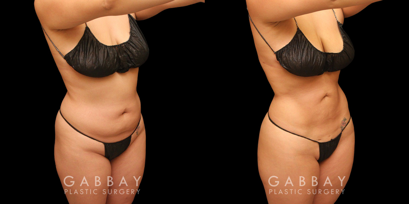 Female abdominal fat removal results showcasing a patient’s flatter tummy area, with no side effects from the liposuction procedure. The fat removed is permanently gone, with straightforward maintenance of results.