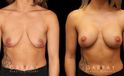 Procedures Depicted:  Mastopexy with Breast Augmentation