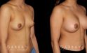 Breast augmentation patient results with silicone implants after fully healed. Breast size increased by multiple cups while keeping a natural balance between breast size and the patient’s body type.