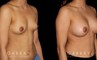 Breast augmentation patient results with silicone implants after fully healed. Breast size increased by multiple cups while keeping a natural balance between breast size and the patient’s body type.