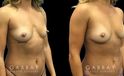 Patient 12 3/4th Right Side View Breast Fat Grafting Gabbay Plastic Surgery