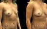Patient 12 3/4th Right Side View Breast Fat Grafting Gabbay Plastic Surgery
