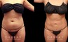 Results of a safe abdominal liposuction surgery that provided this female patient with notable slimming. Note the flat stomach from the profile view with no overhang above the waistline.