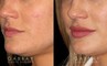 Patient 03 3/4th Left Side View Lip Augmentation Gabbay Plastic Surgery