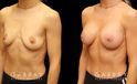 Silicone breast augmentation results after full recovery. Multi-angle view shows the boost to volume from each side for an alluring profile.